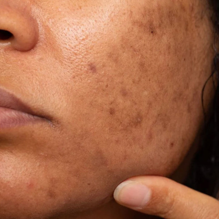 Dark Spots / Hyperpigmentation