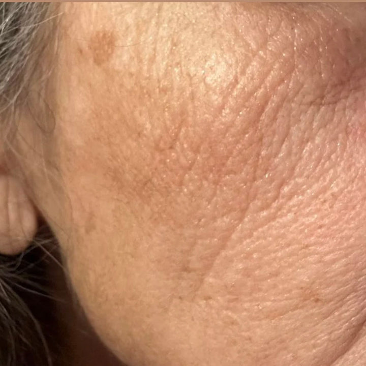 Aging Skin