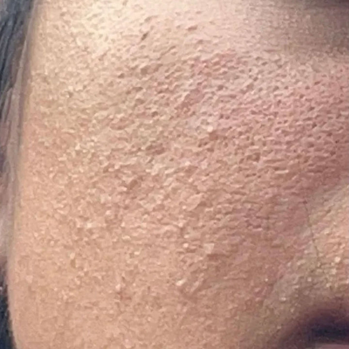 Dehydrated / Dry Skin